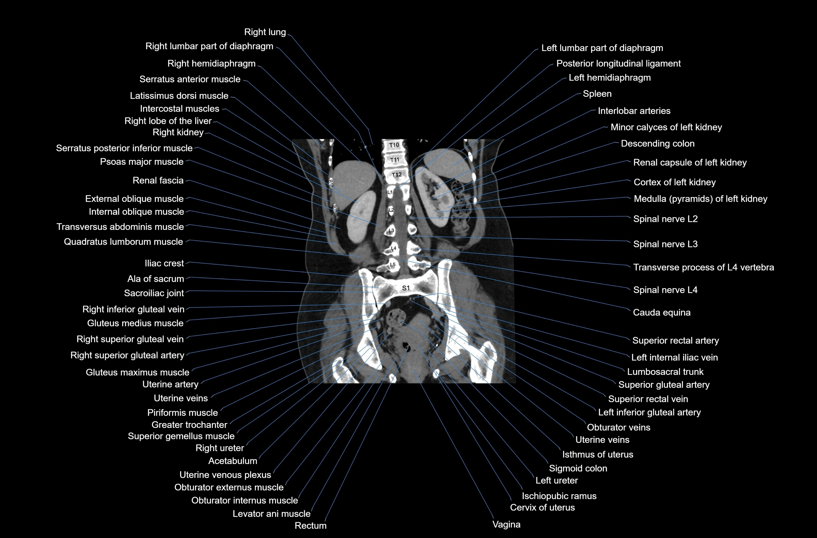 CT abdomen coronal cross sectional anatomy labelled radiology image-00061.webp